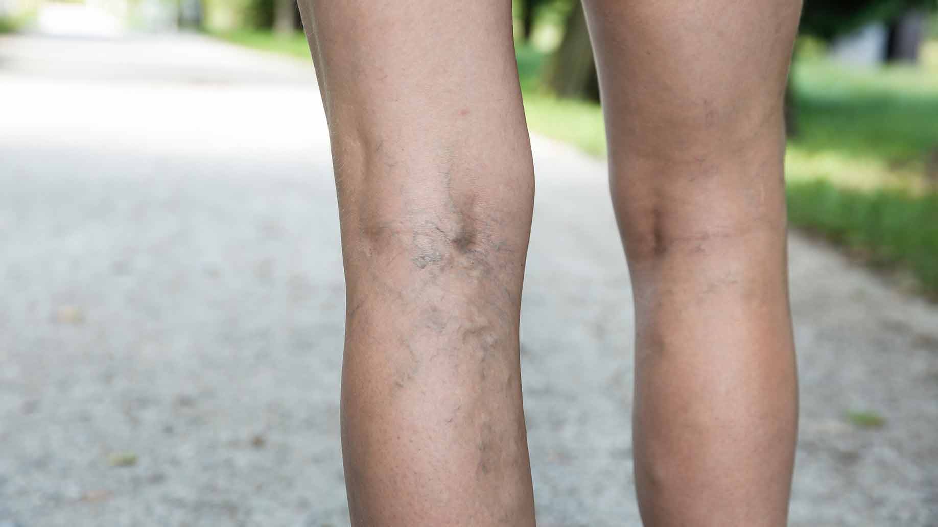 varicose spider veins in legs